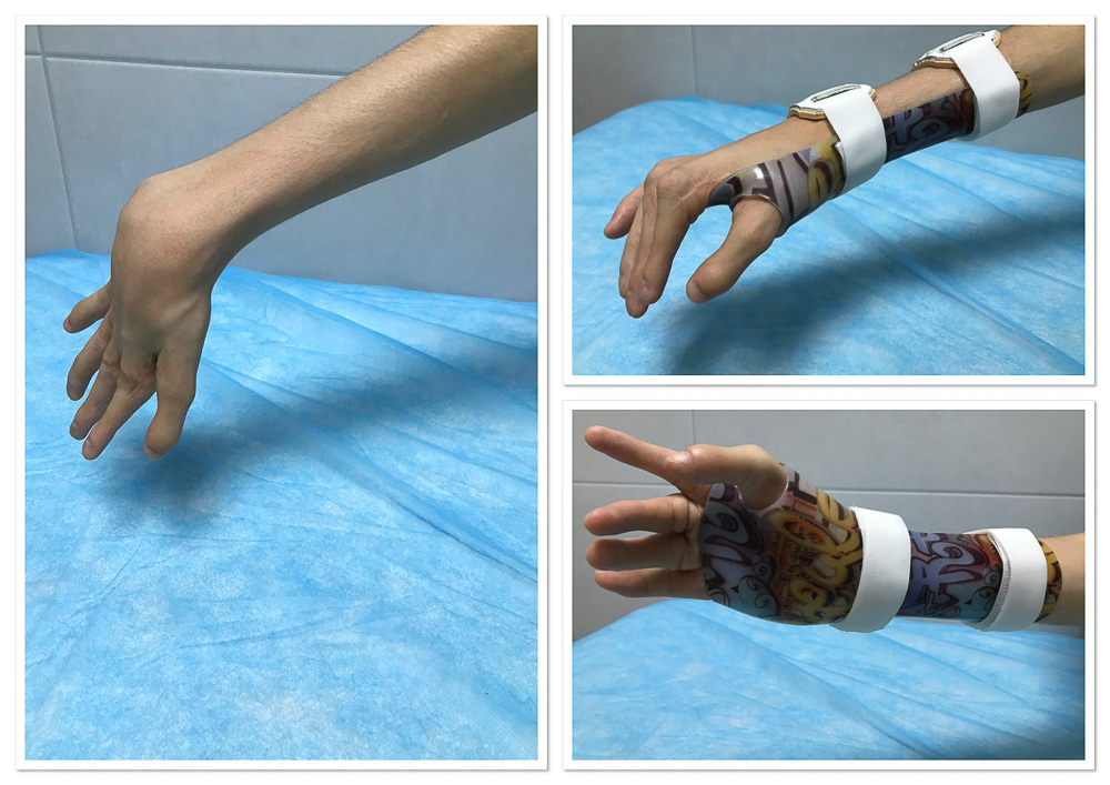 Ortesis en posición funcional de muñeca y mano para paciente con rigidez articular y espasticidad