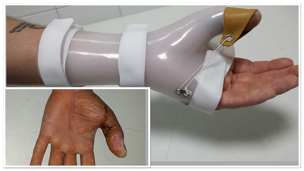 Ortesis para control de articulación de dedo pulgar tras intervención quirúrgica