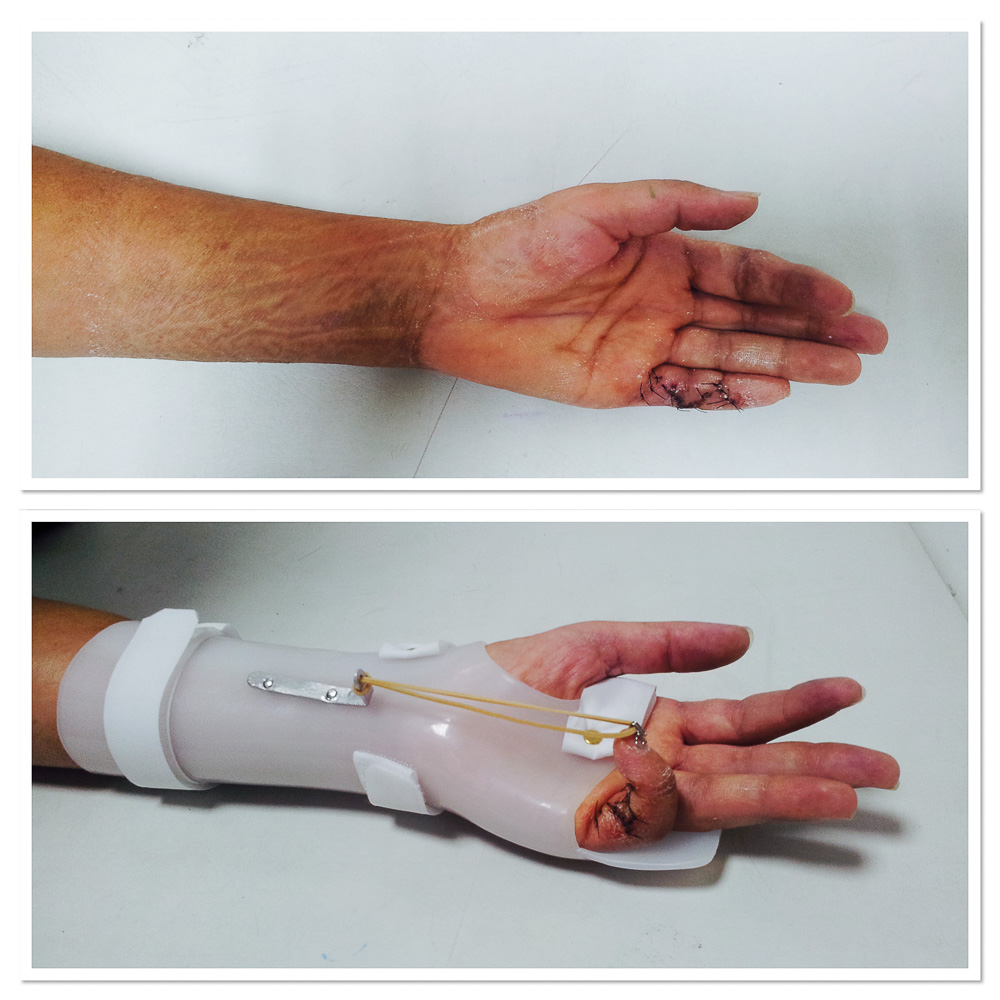 Ortesis para controlar la extensión de 5º dedo tras intervención quirúrgica